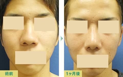 美鼻整形症例写真02