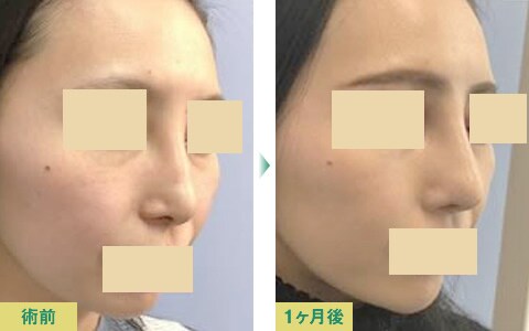 美鼻整形症例写真03
