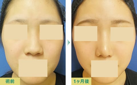 美鼻整形症例写真04