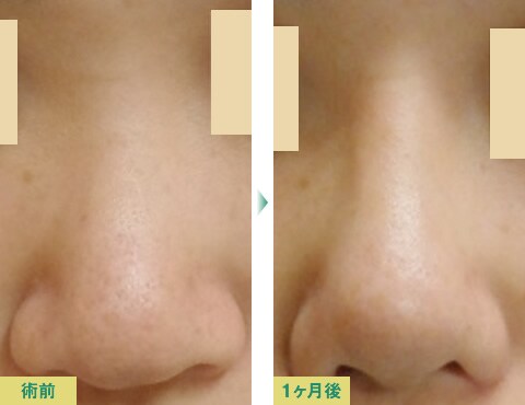 美鼻整形症例写真05