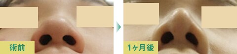 美鼻整形症例写真07