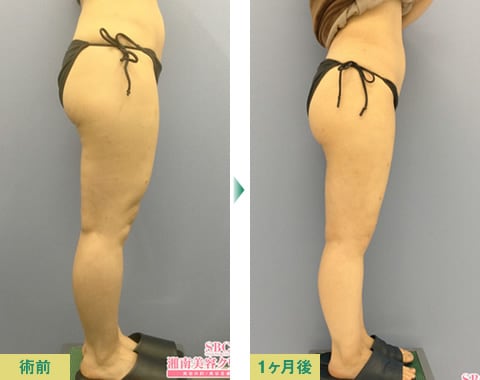 脂肪吸引症例写真03