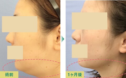 脂肪吸引症例写真07