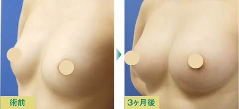 脂肪注入豊胸症例写真02