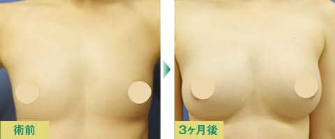 脂肪注入豊胸症例写真04
