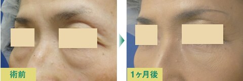 脂肪注入豊胸症例写真01