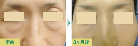 脂肪注入豊胸症例写真02