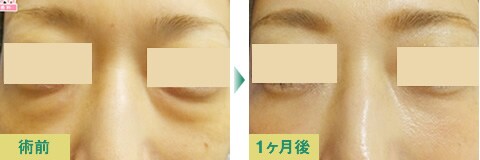 脂肪注入豊胸症例写真04
