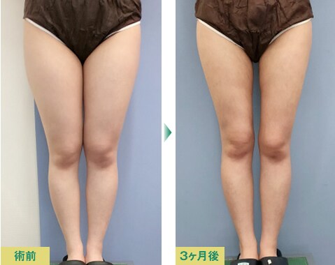 脂肪吸引症例写真03