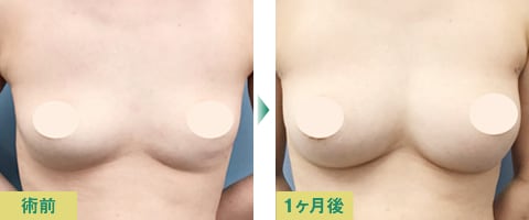 脂肪注入豊胸症例写真04