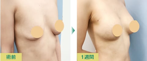 脂肪注入豊胸症例写真03