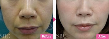 Before After
