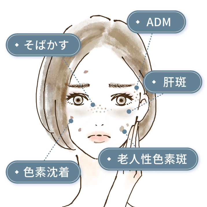 老人性色素斑（一般的なシミ） そばかす 肝斑 色素沈着 ADM