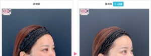 ナチュラル脂肪注射（脂肪注入）の症例写真