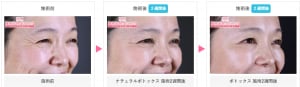 ボトックスの症例写真