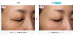 女優注射の症例写真