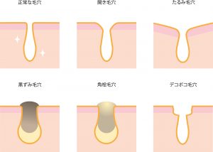 毛穴の種類