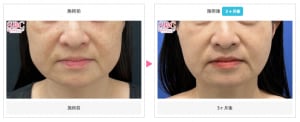 エラボトックスの症例写真