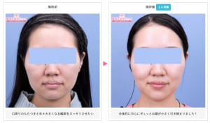 サーマクールの症例写真
