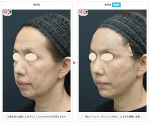 ヒアルロン酸の症例写真