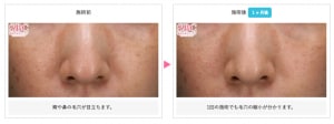 リジュランボトックスの症例写真