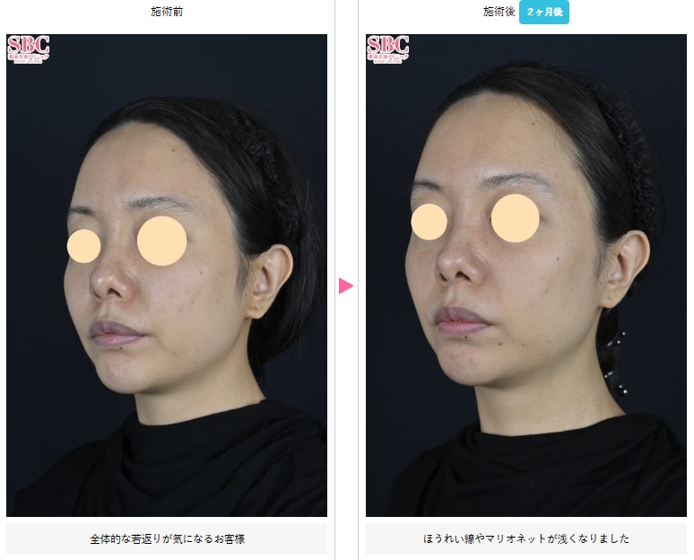 プロファイロの症例写真