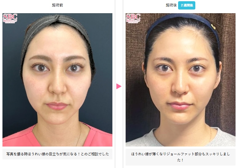 糸リフトの症例写真