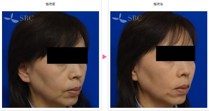 ヒアルロン酸の症例写真