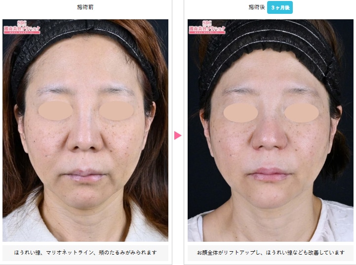 プロファイロの症例写真