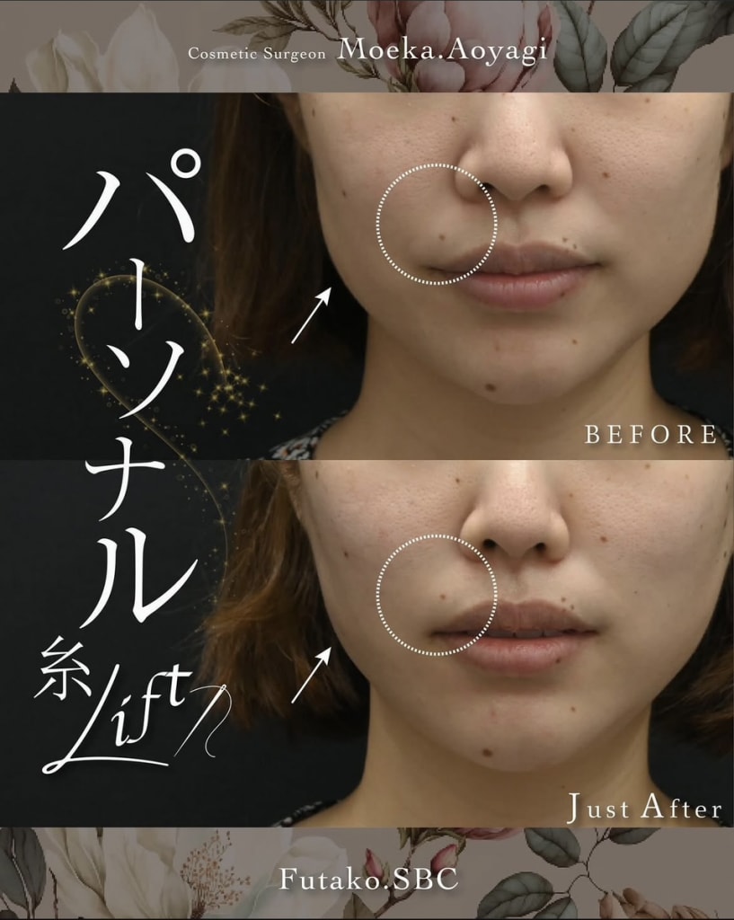 糸リフトの症例写真