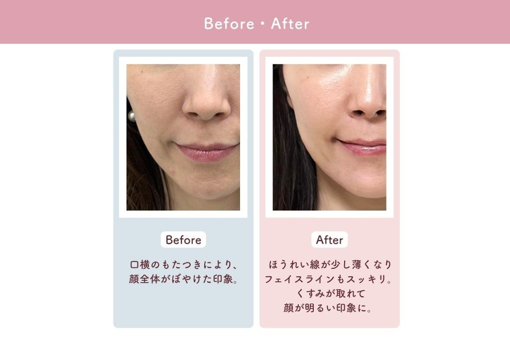Akiho Before After写真