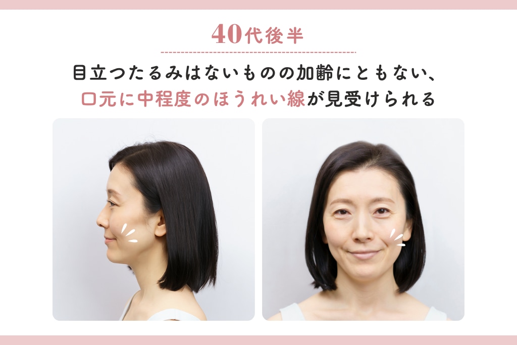 ほうれい線モデル画像