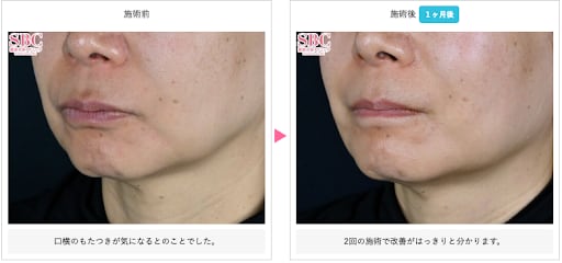 SBCトキシルスレッドの症例写真