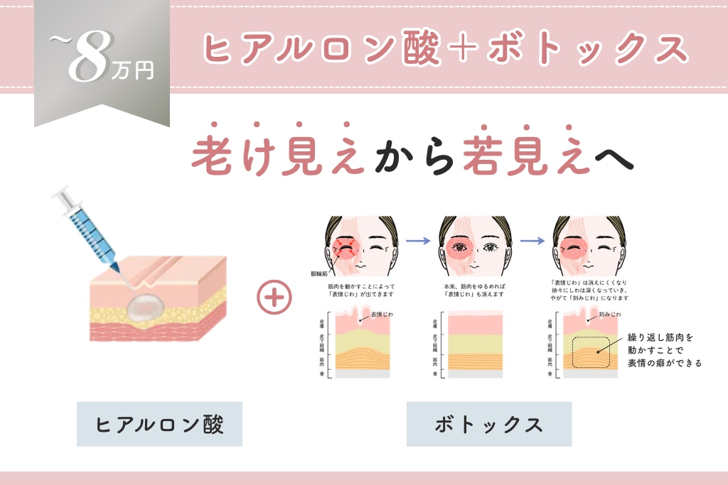 8万円 ヒアルロン酸＋ボトックス