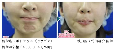 ボトックス注射・注入（アラガン）の症例写真