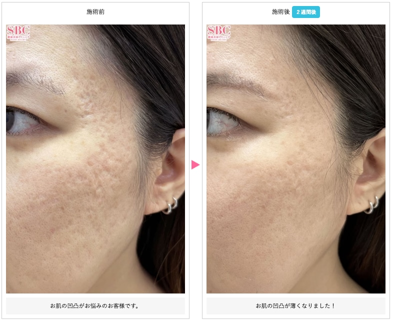 玉の肌ダーマペン（ACRS自己血サイトカインリッチ療法）の症例写真