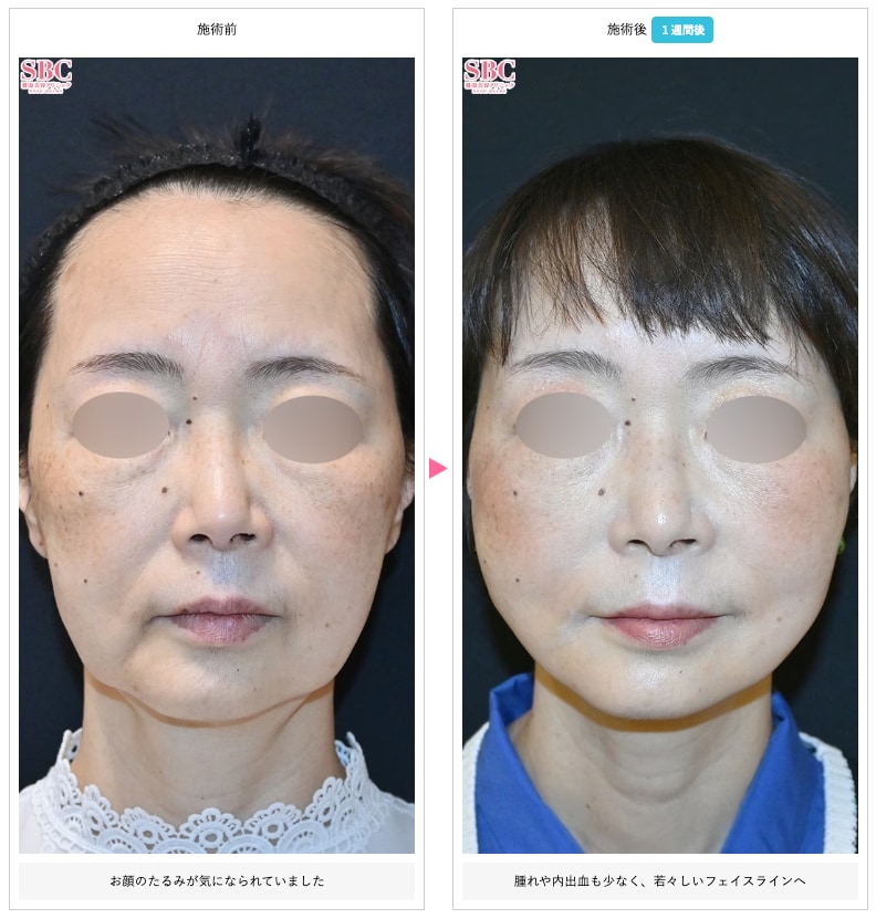 糸リフトの症例写真