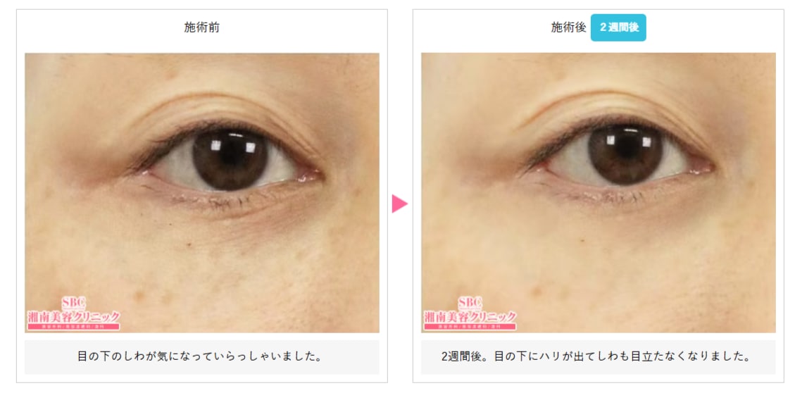 リジュランiの症例写真