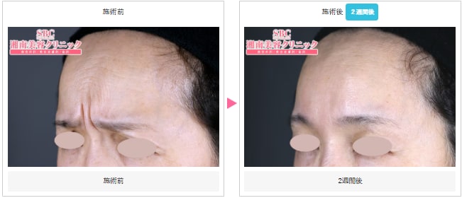 しわ取りボトックスの症例写真