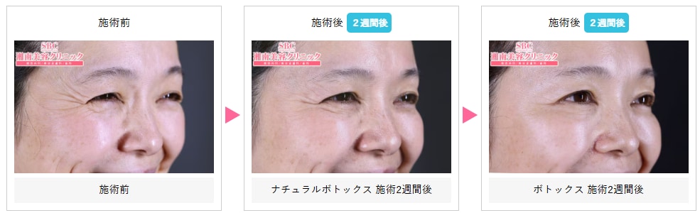 目尻のしわ取りボトックスの症例写真
