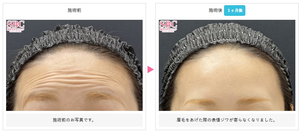 額ボトックスの症例写真
