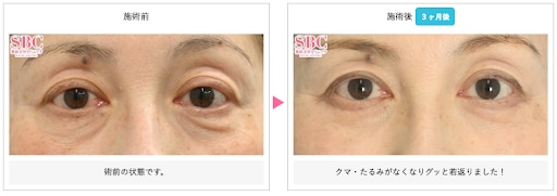 アイバックリムーブ法+眼輪筋弁作成料の症例写真