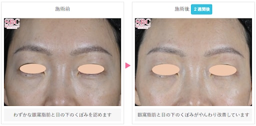 くまぴたスレッドの症例写真