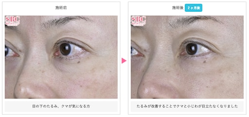 モフィウス８の症例写真