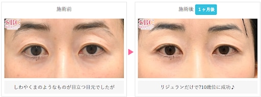 リジュランiの症例写真