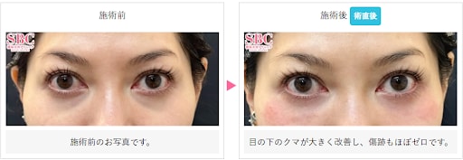 ベビーコラーゲン（ヒューマラジェン／ベビーダーム）の症例写真