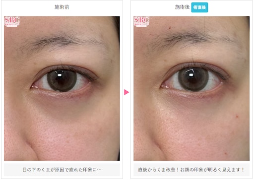 デューコラーゲン（Deusaderm）の症例写真