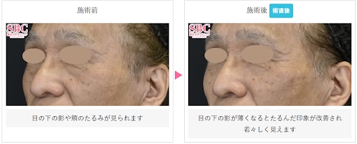 ヒアルロン酸の症例写真