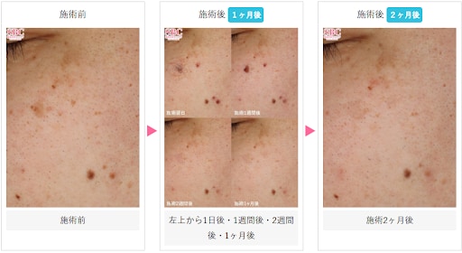 シミ取りレーザー10の症例写真