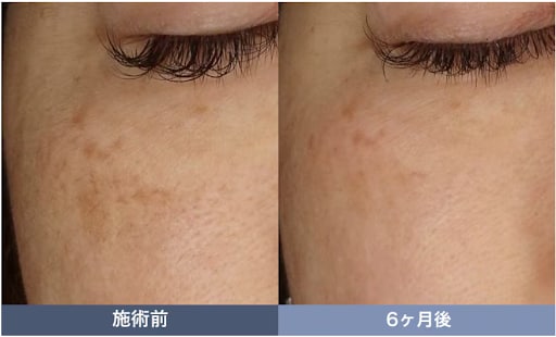 レーザートーニング/肝斑治療の症例写真